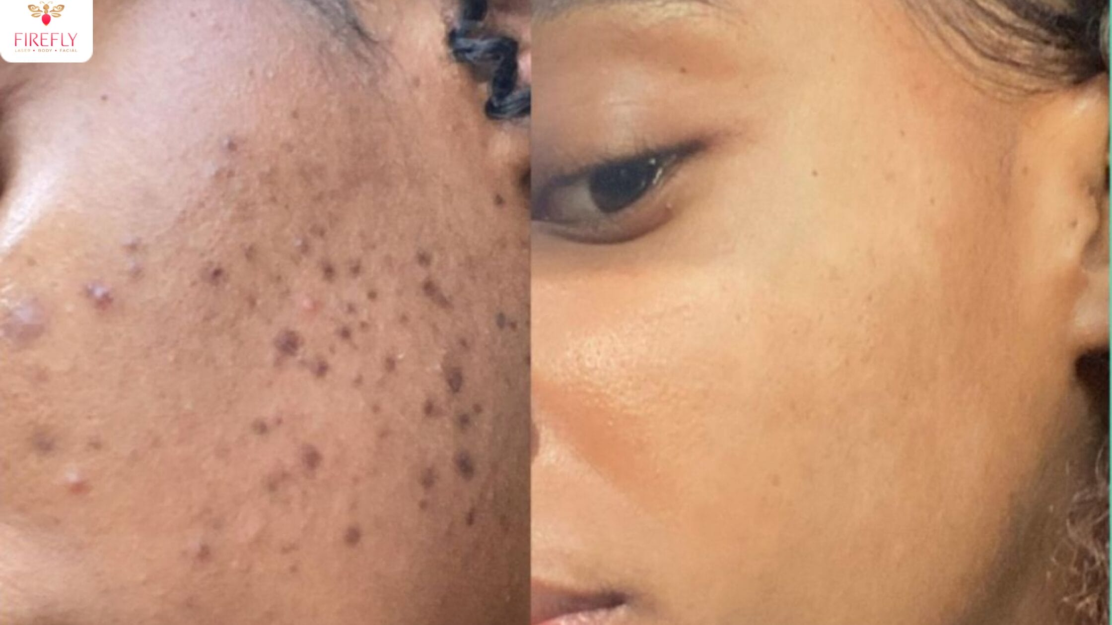 Before and after Hydrafacial results showing clearer and brighter skin.