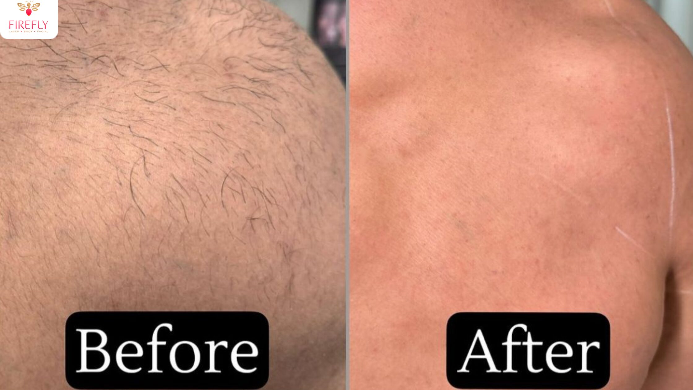 Laser hair removal aftercare for men in Bali including avoiding gym surf and sun exposure after treatment