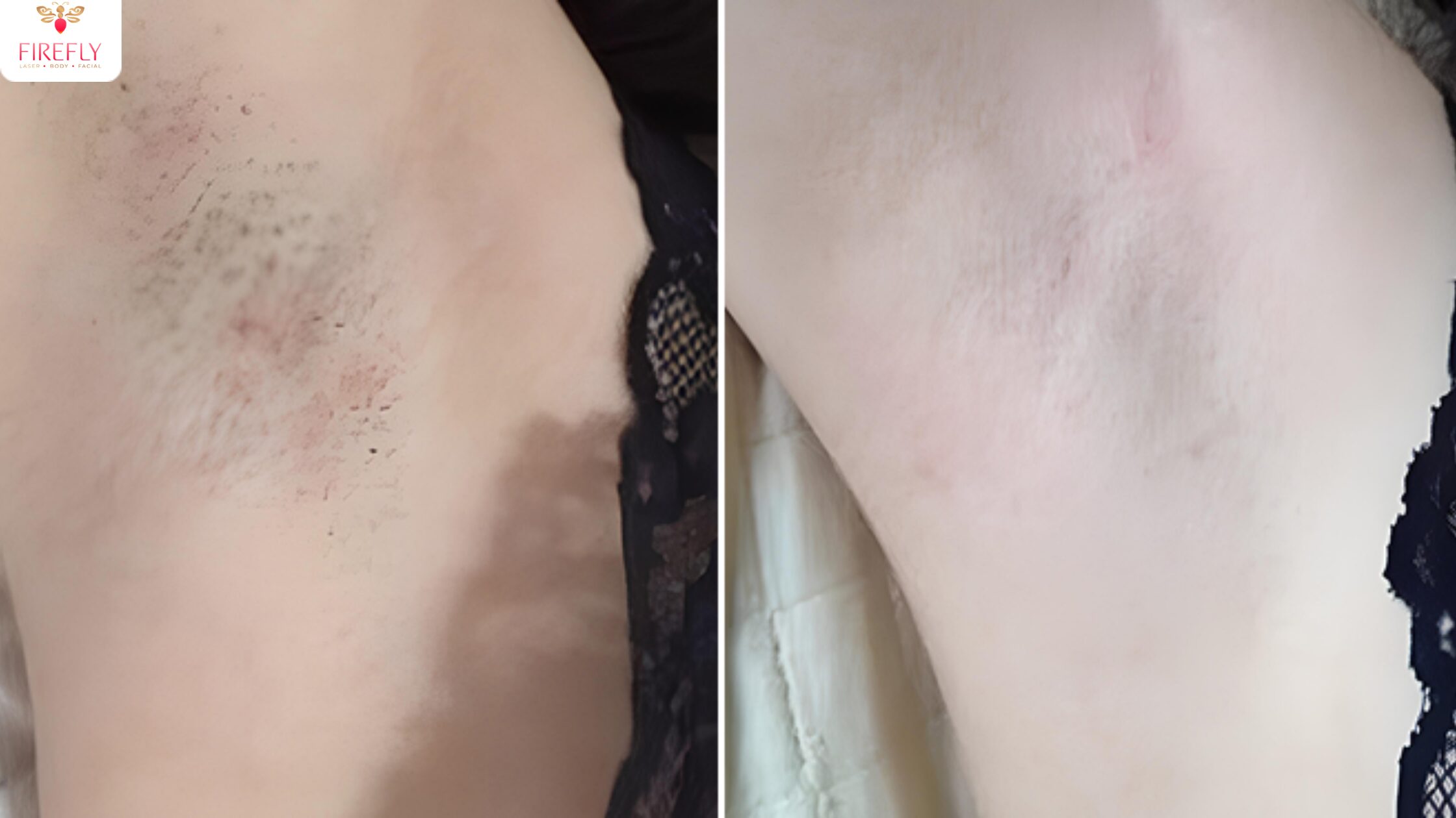 Brazilian laser hair removal in Bali for smooth, safe, and long-lasting bikini area results