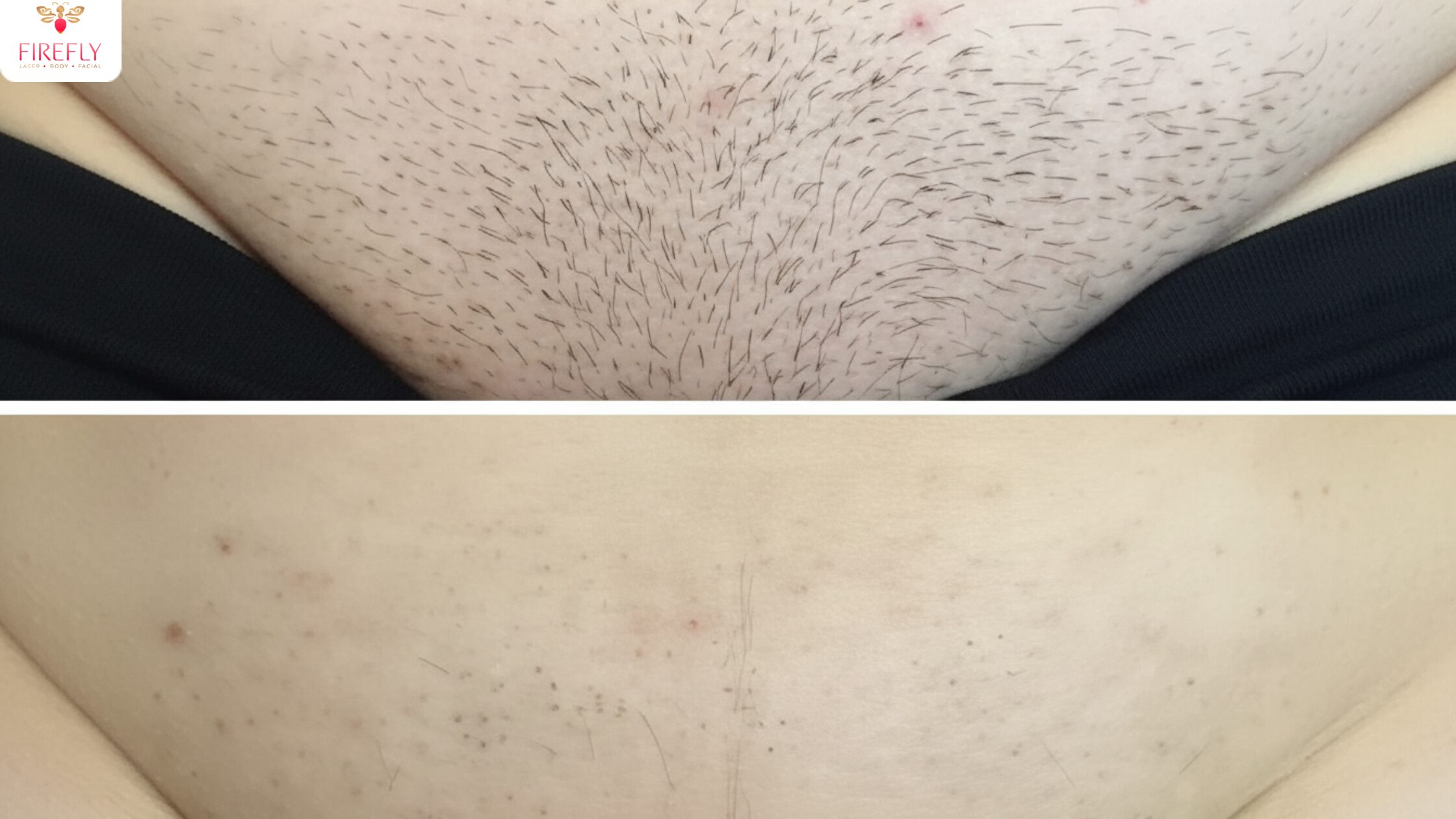 Brazilian laser hair removal treatment for bikini line and intimate area in Bali