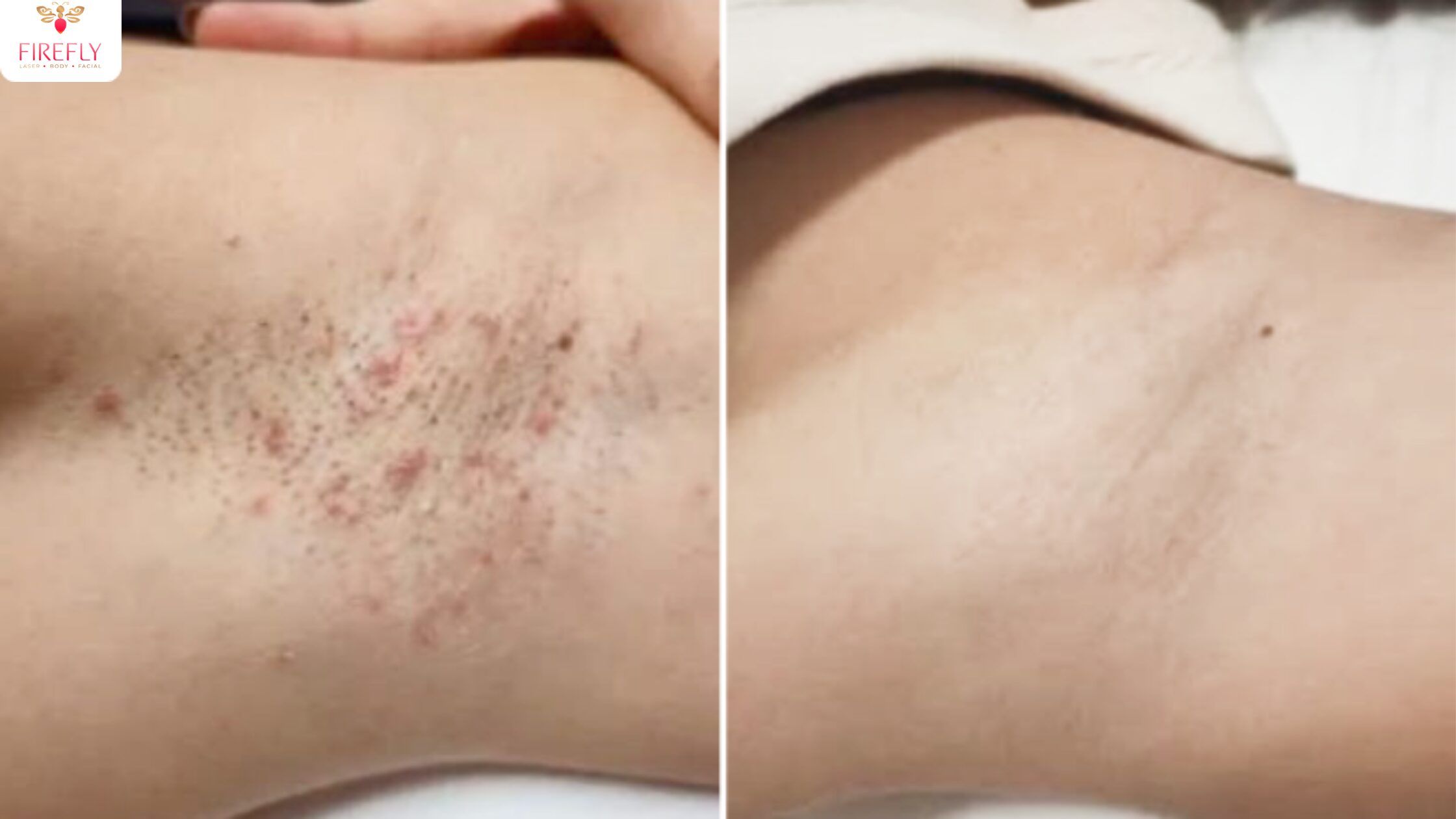 Brazilian laser hair removal treatment for bikini line and intimate area in Bali