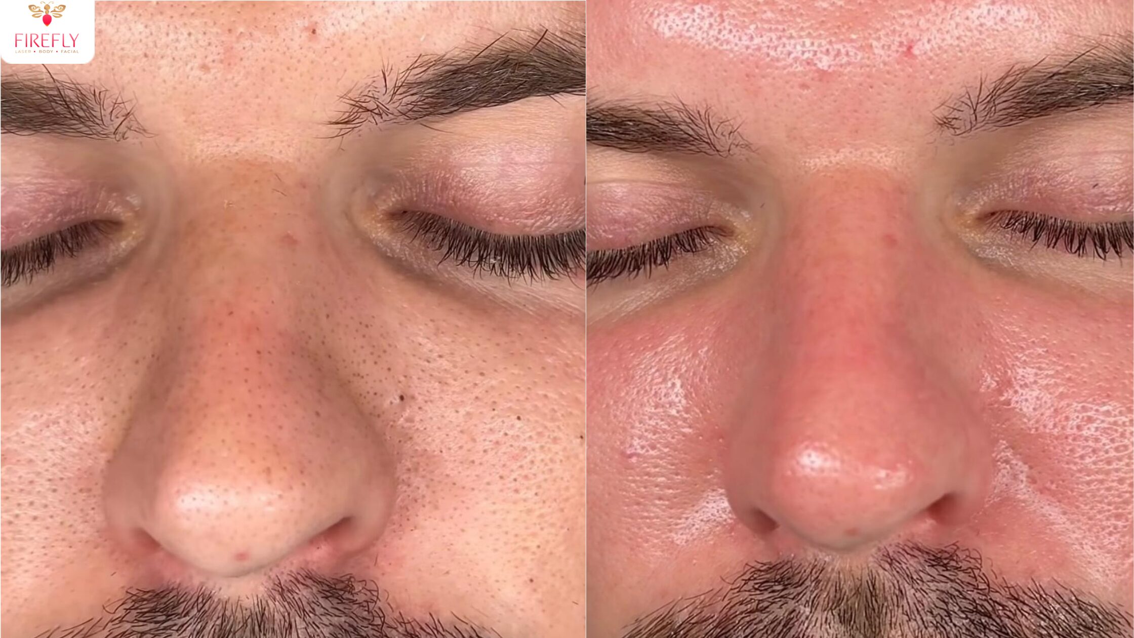 Before and after HydraFacial results showing brighter, clearer, and more hydrated skin.