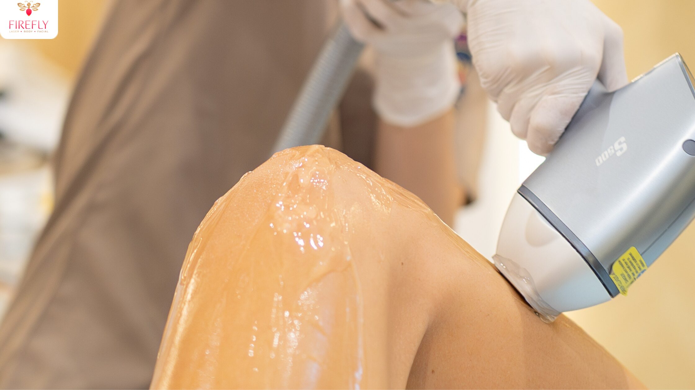 laser hair removal in bali