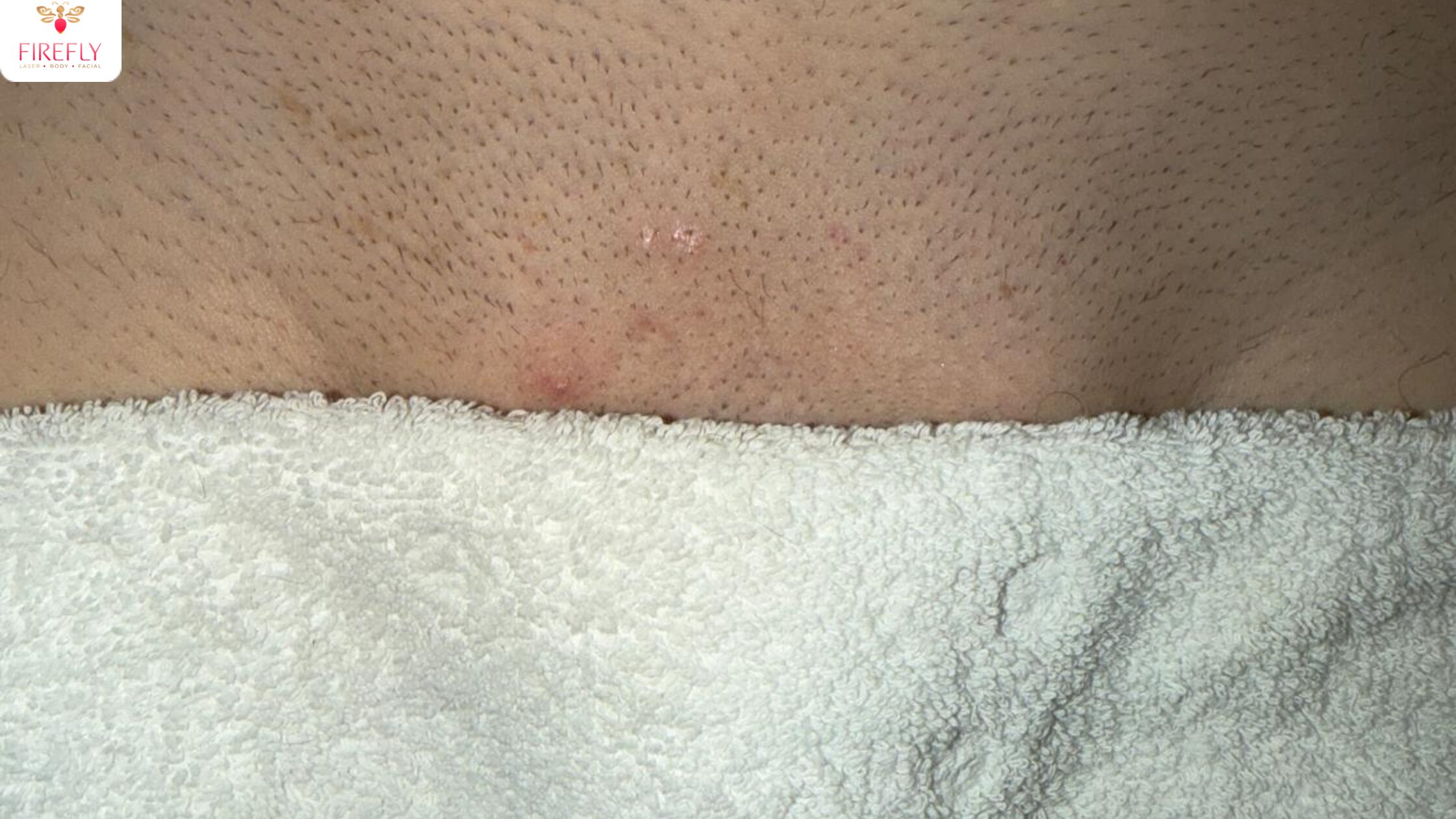 Close-up of hair follicles on skin before laser hair removal treatment