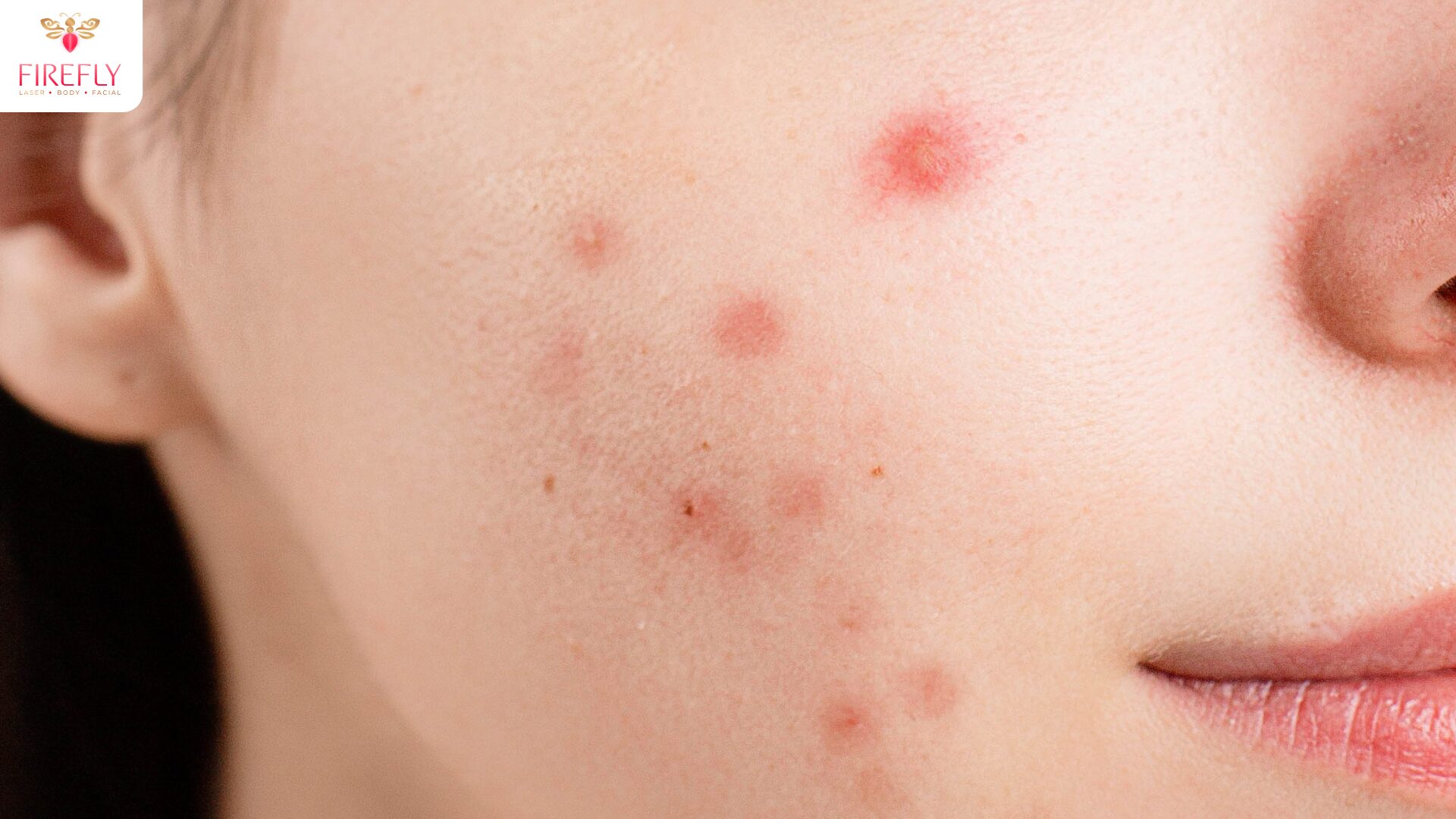 Close up of mild acne breakouts and post facial skin purging