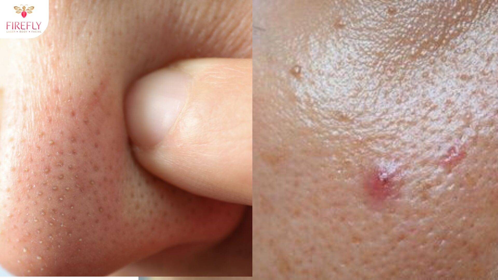 Clogged pores vs clean pores skin comparison