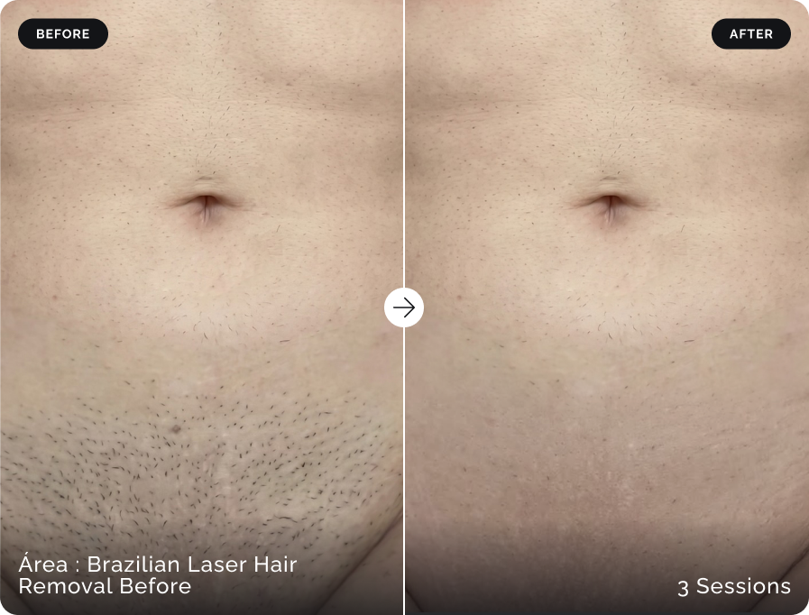 Before and after Brazilian laser hair removal after three sessions at Firefly Canggu