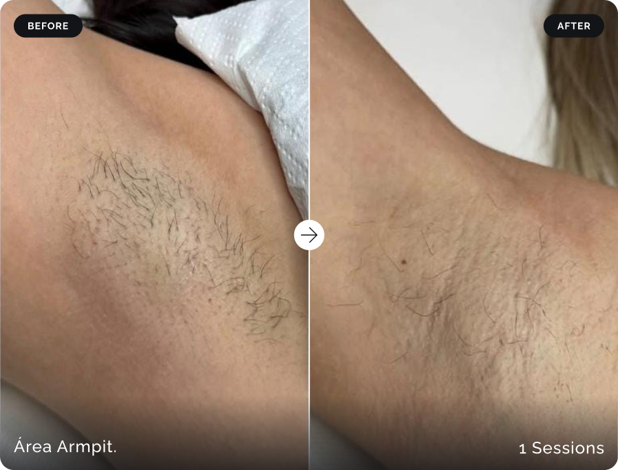 Before and after underarm laser hair removal after one session at Firefly Canggu