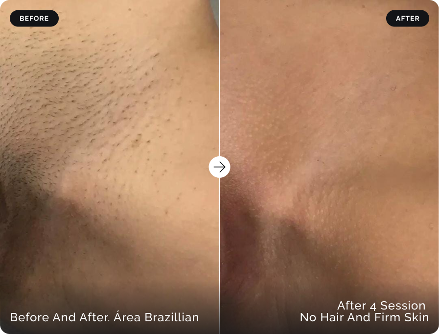 Before and after Brazilian laser hair removal after four sessions at Firefly Canggu