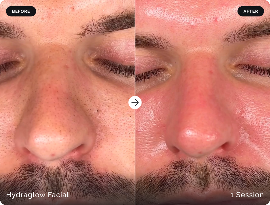 Before and after Hydraglow Facial after one session at Firefly Canggu