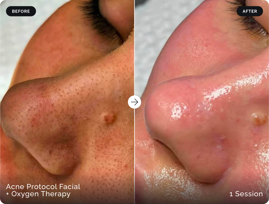 Before and after Acne Protocol Facial with oxygen therapy after one session at Firefly Canggu