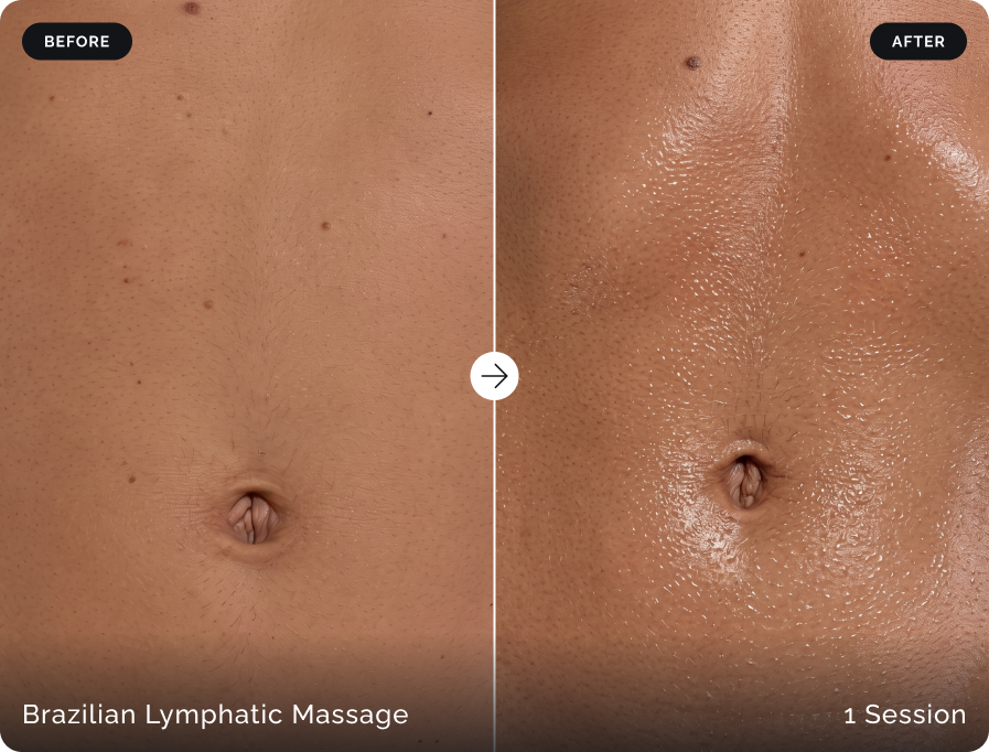 Before and after Brazilian lymphatic massage after one session at Firefly Canggu