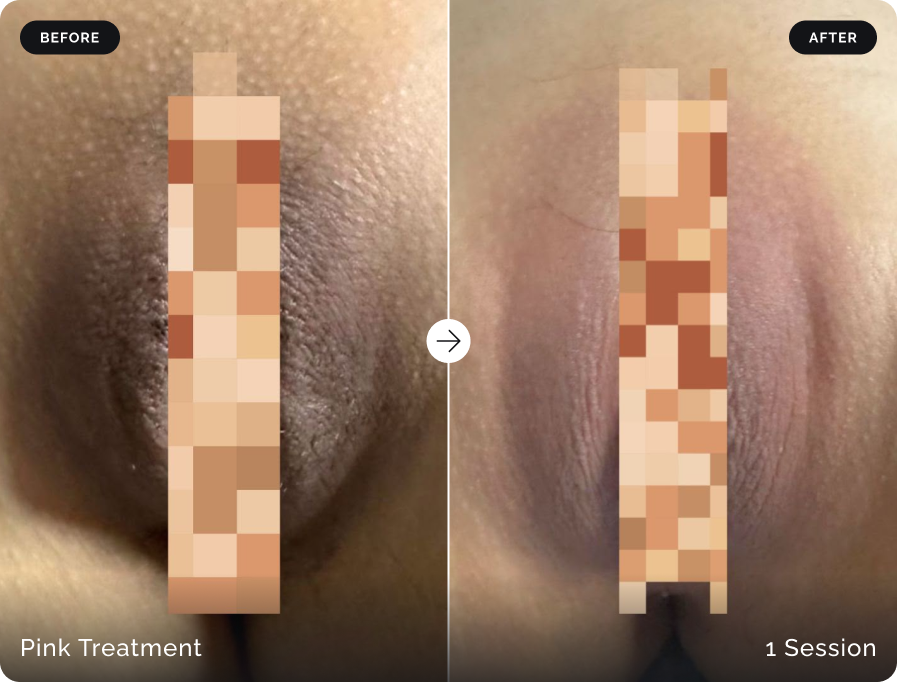 Before and after Pink Treatment intimate skin brightening after one session at Firefly Canggu